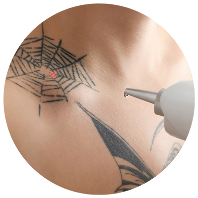 Remoção de TATOO