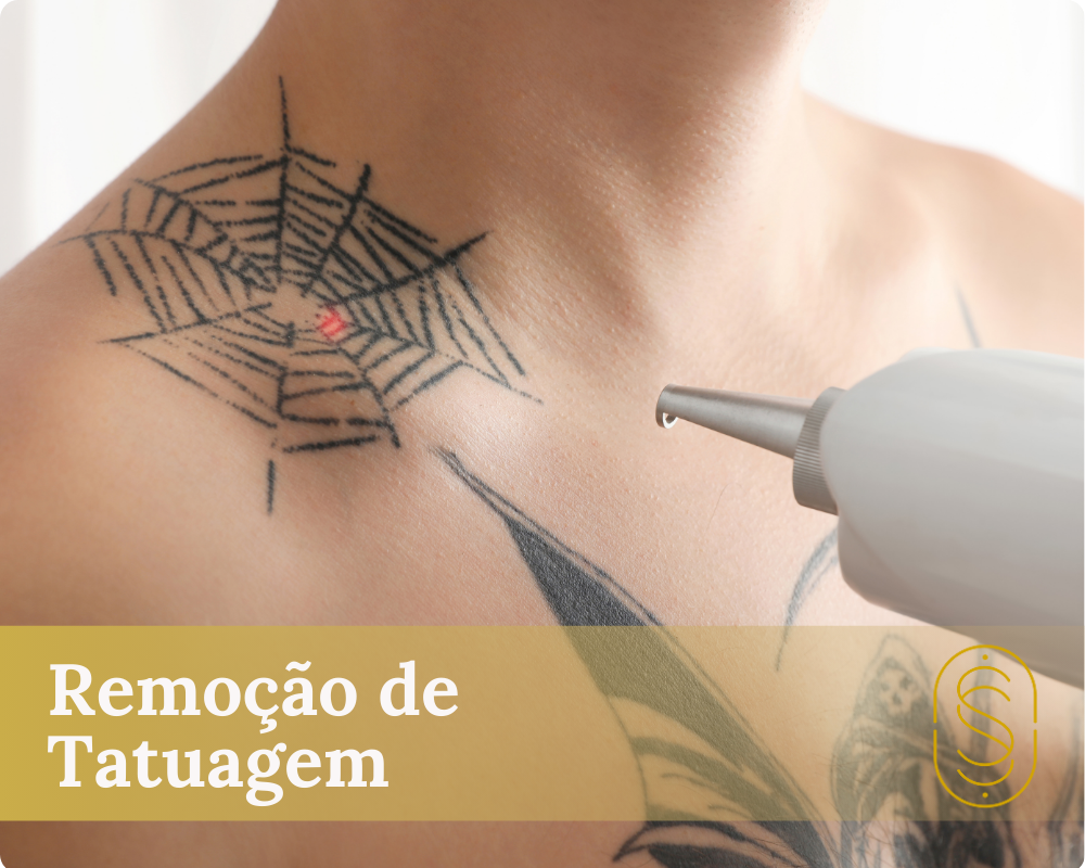Remoção de Tatuagem