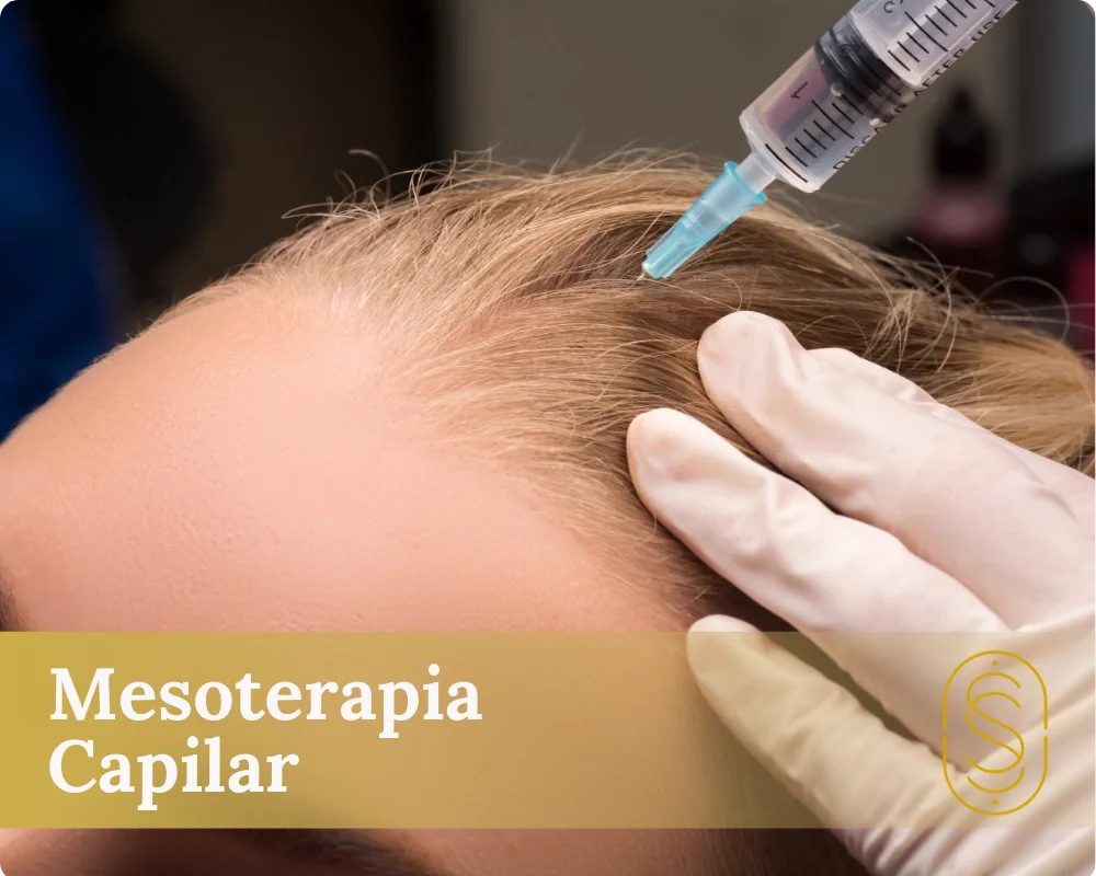 Mesoterapia Capilar