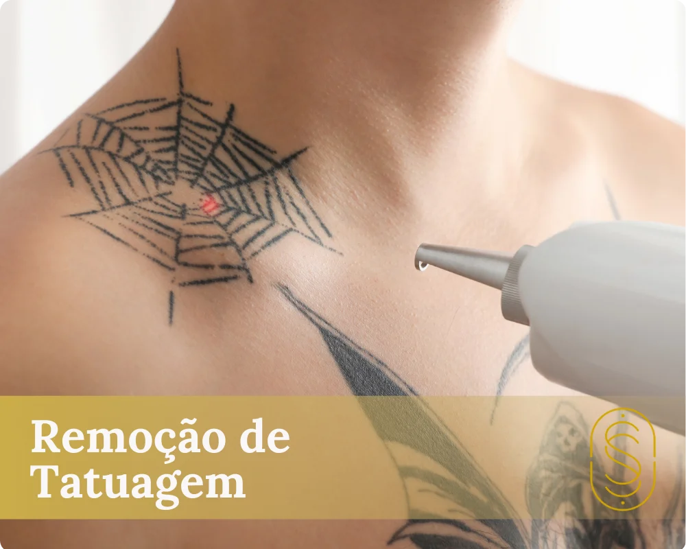 Remoção de Tatuagem